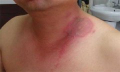 隱翅蟲皮炎的護理方法，隱翅蟲皮炎用什么藥？